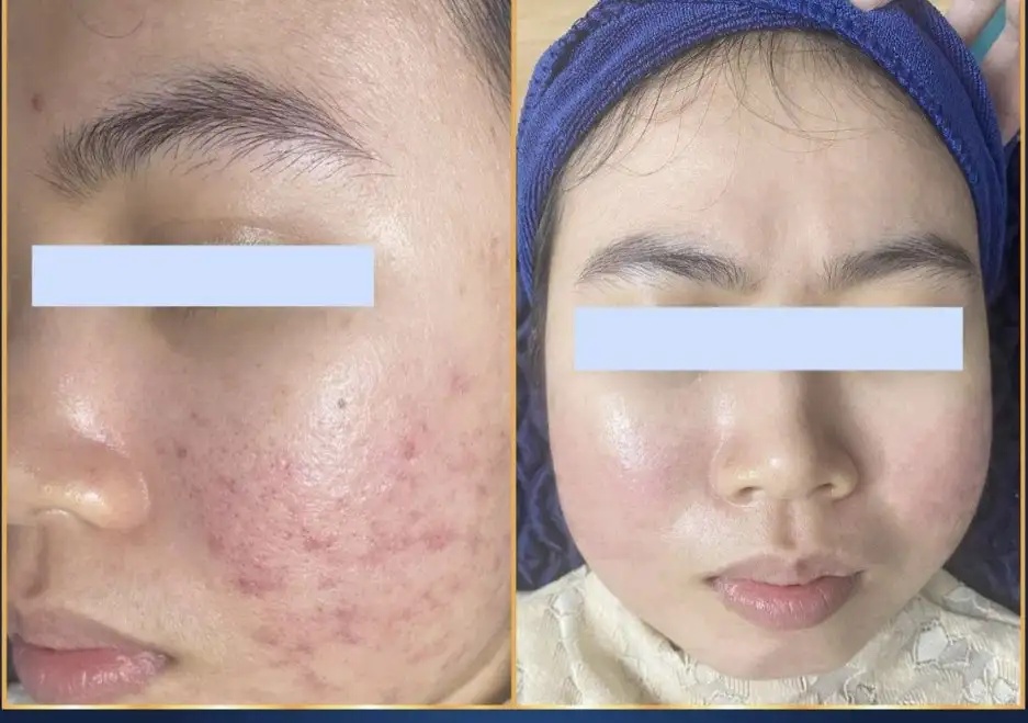Why Skin Treatment Results Are Different for Each Person