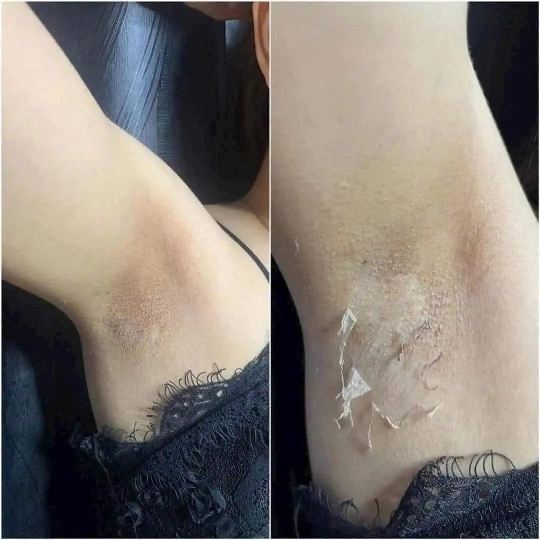 Pores and Rough Skin Texture Treatment in Poipet