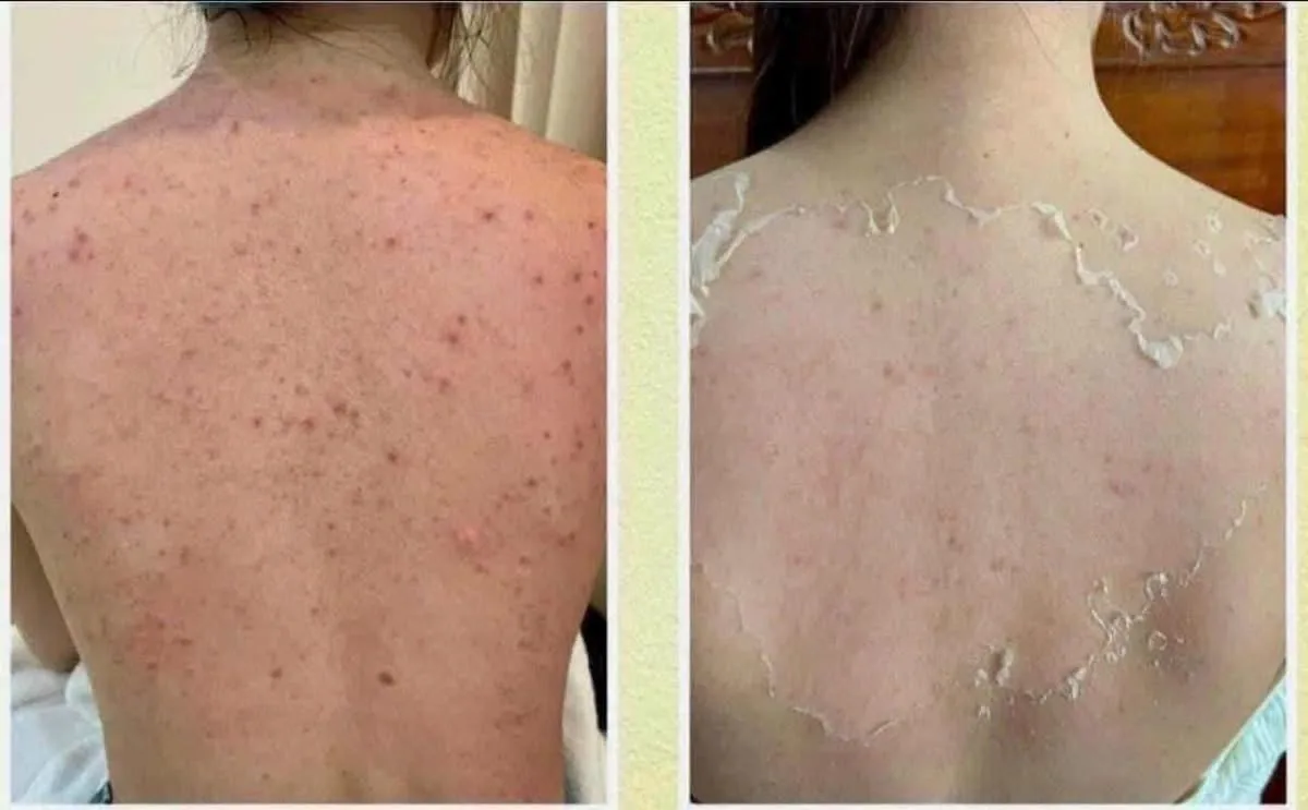 Body Beauty and Hair Removal in Poipet: Body Acne, Dark Areas, Hair Removal and Skin Brightening