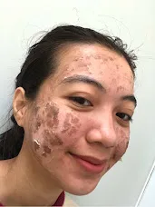 Why Laser Makes Melasma Worse — And What to Do Instead