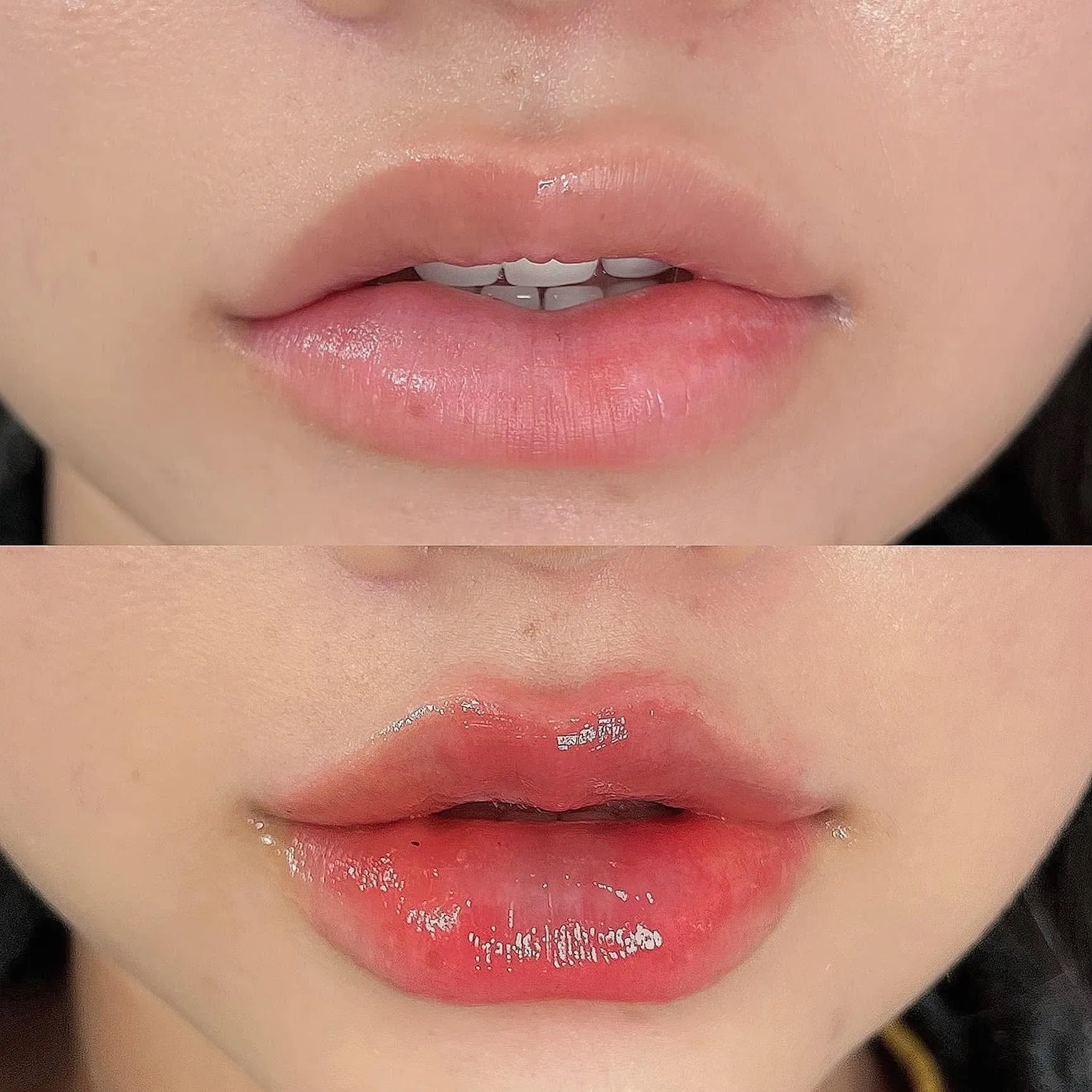 Filler Vascular Occlusion — Emergency Signs After Filler Injection