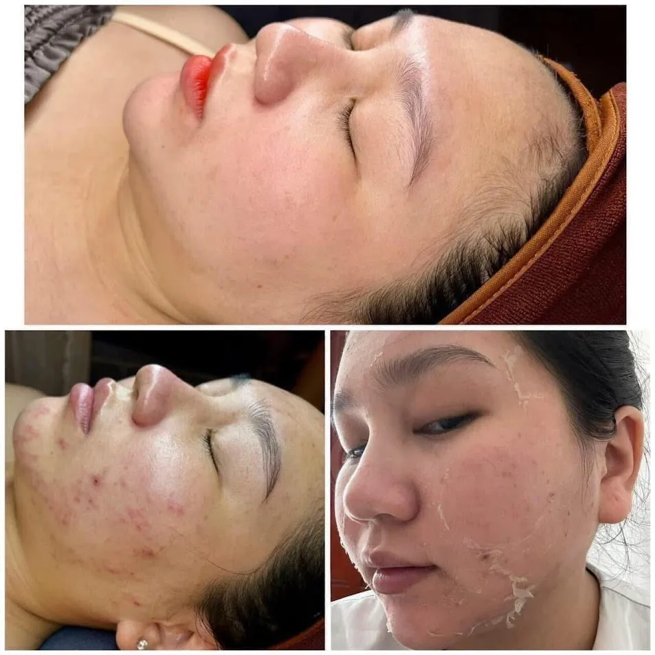 After Laser, Peel or Microneedling — What Is Normal and What Is Not