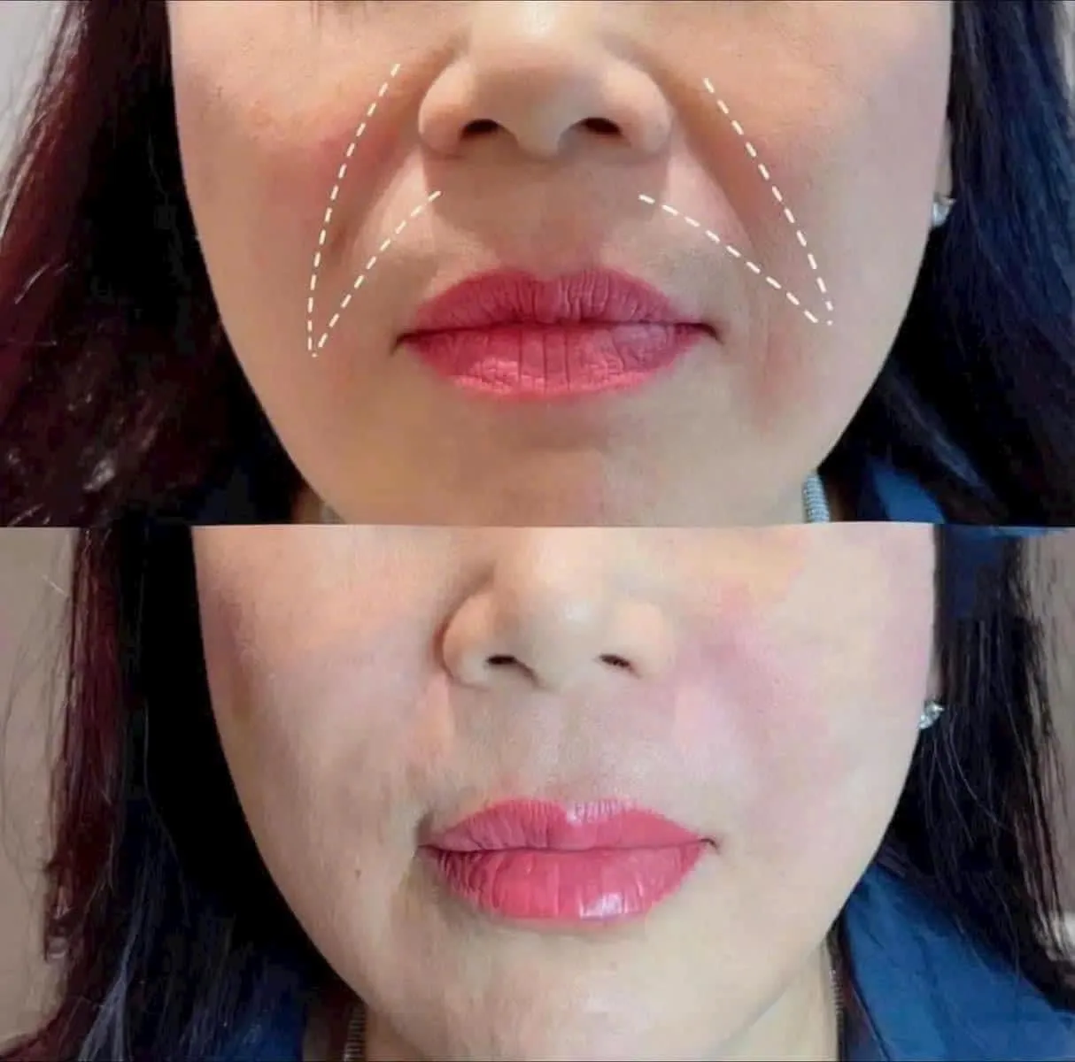 Filler Vascular Occlusion — Emergency Signs After Filler Injection