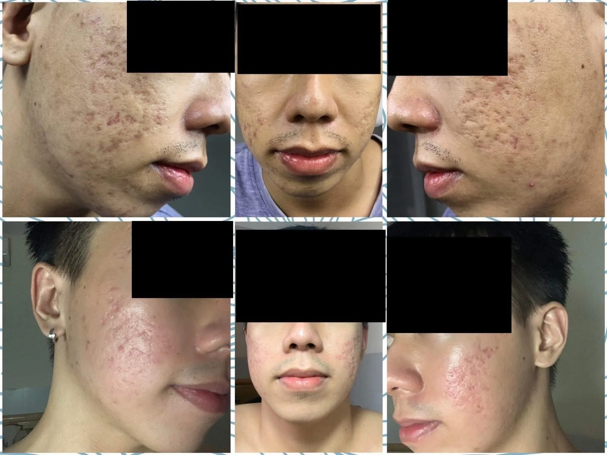 Keloid and Scar Treatment in Poipet