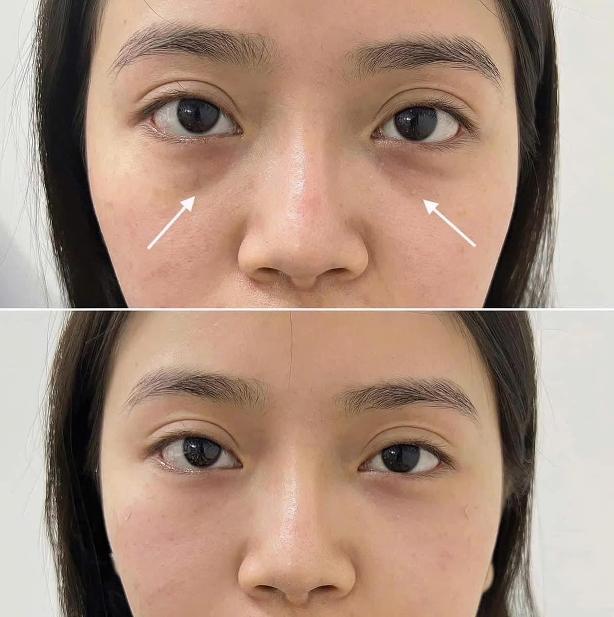 Melasma and Pigmentation Treatment in Poipet