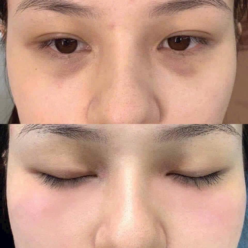 Melasma and Pigmentation Treatment in Poipet