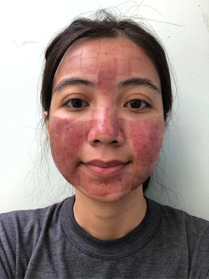 Why Laser Makes Melasma Worse — And What to Do Instead