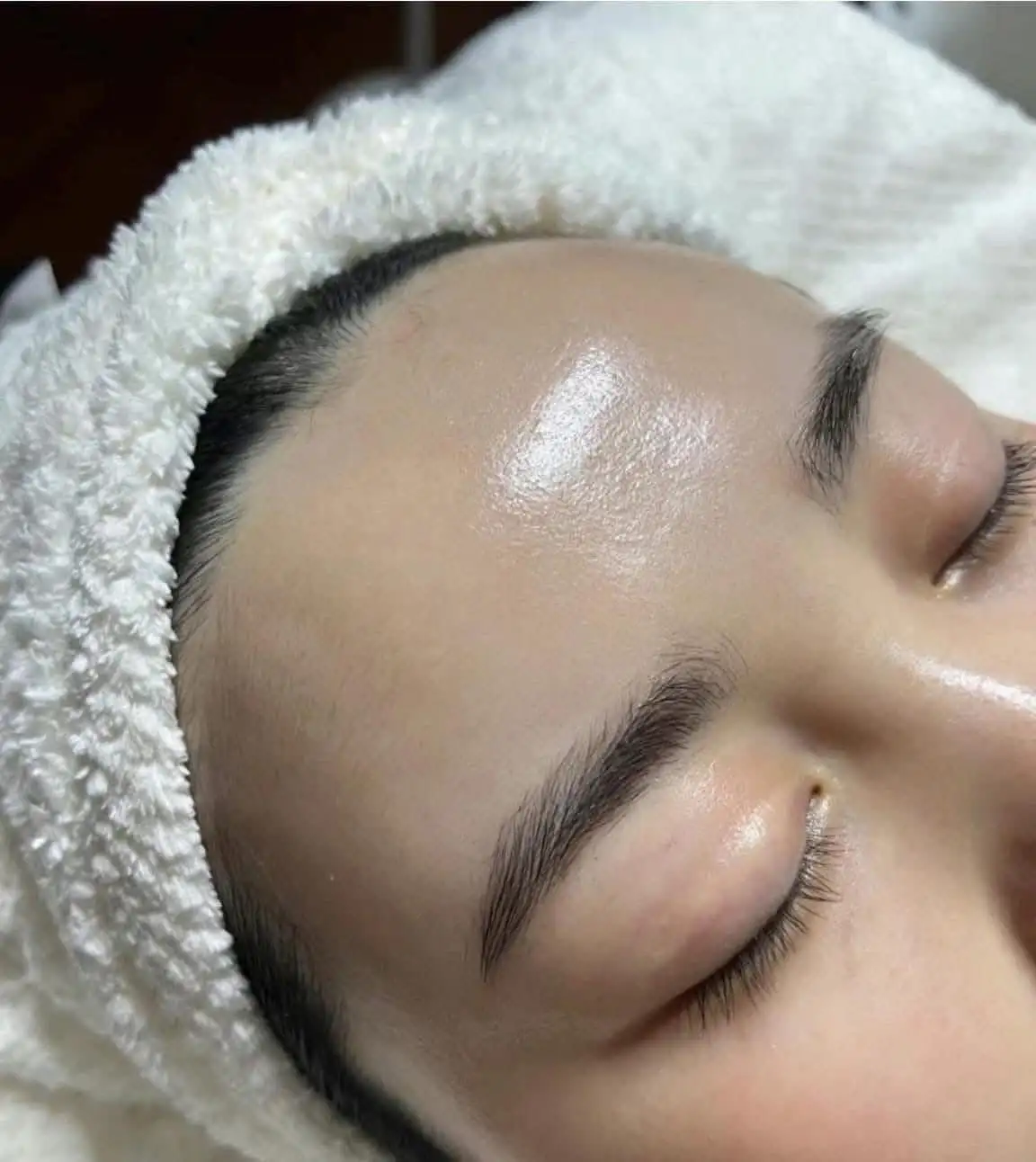 PRP, Rejuran and Regenerative Skin Treatments in Poipet