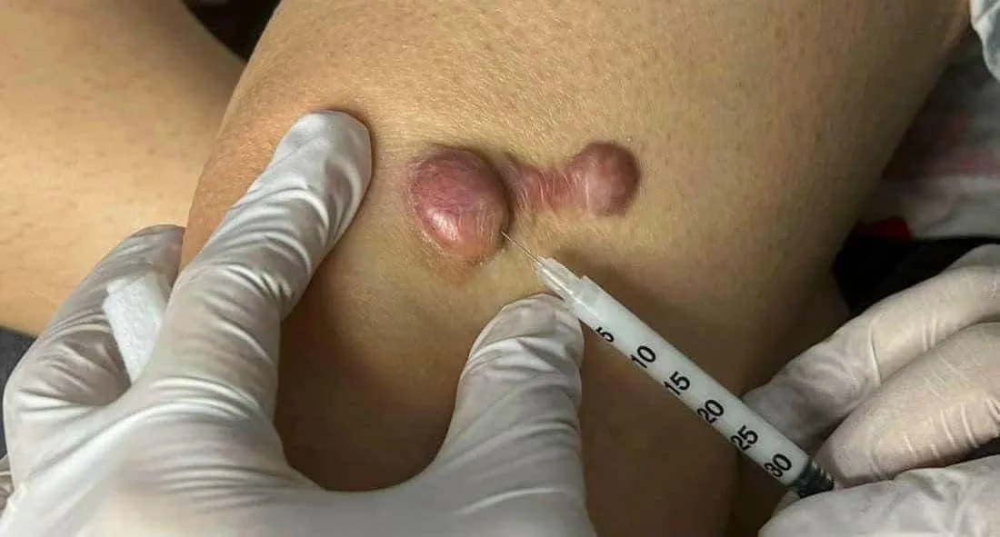 Keloid and Scar Treatment in Poipet